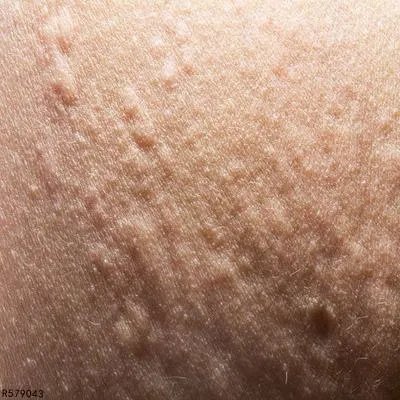 皮肤淀粉样变是怎么引起的