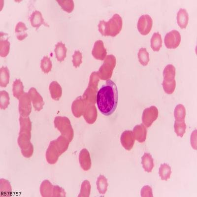 淋巴细胞百分比偏高是什么原因