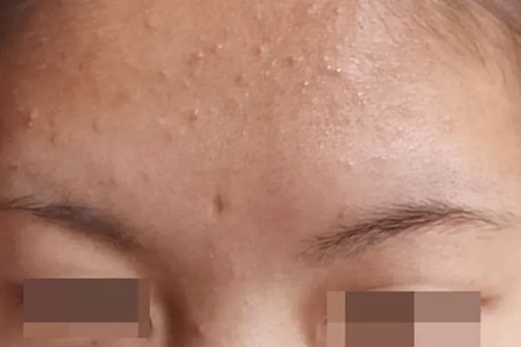 痤疮前额白头粉刺图片