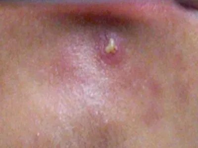 毛囊炎疙瘩图片