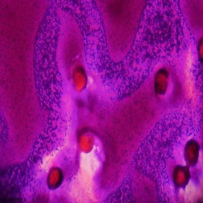 免疫性血小板减少性紫癜对身体有哪些危害