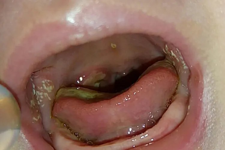 宝宝鹅口疮图片