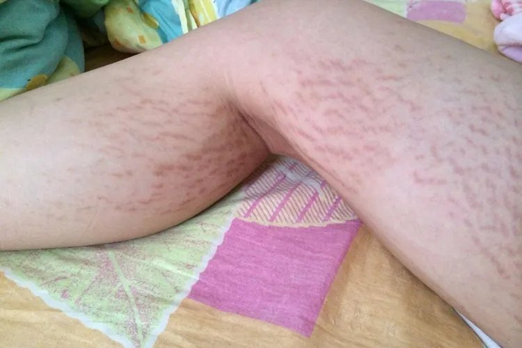 腿部肥胖纹图片