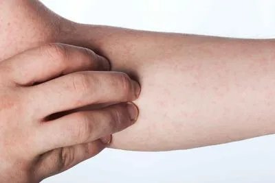 日光性皮炎是什么样的