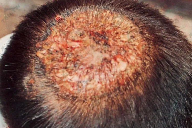 头癣的症状图片