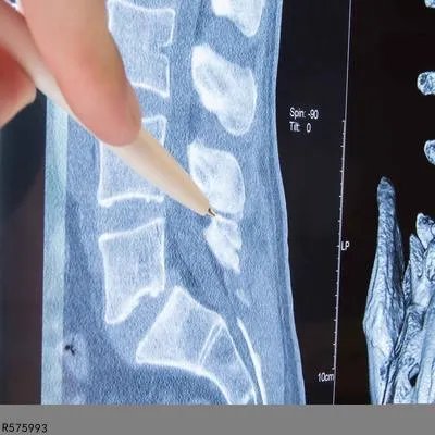 强直性脊柱炎怎么引起 了解引发强直性脊柱炎的主因