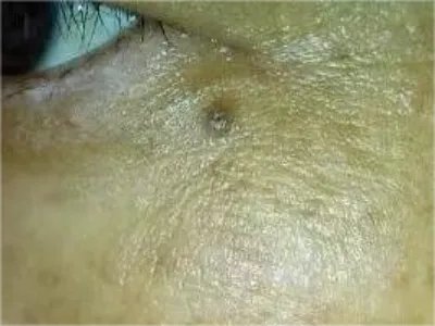 皮内痣黑痣图片