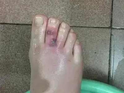 蜱咬伤红肿图片