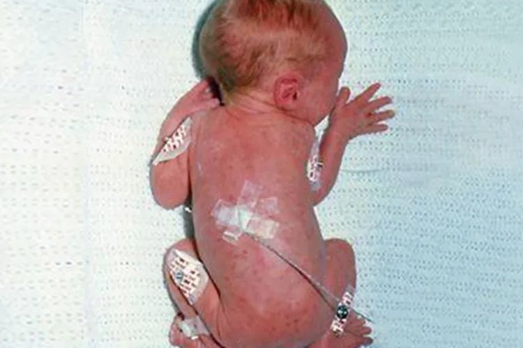 风疹症状图片及病因