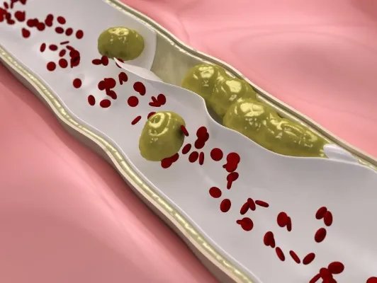 肠系膜上动脉栓塞的原因