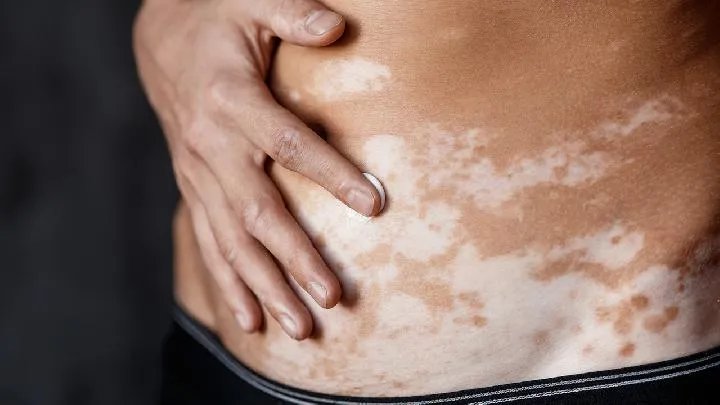 一般情况下患上白癜风传染么