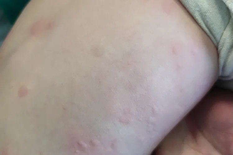 5岁孩子身上起红疙瘩很痒图片