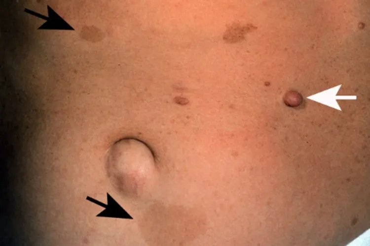 纤维瘤图片辨别