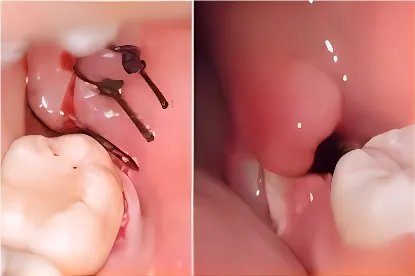 拔牙恢复过程图