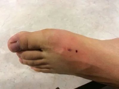 蜱咬伤红肿图片