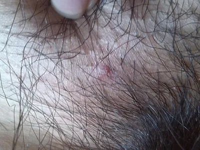 毛囊炎疙瘩图片