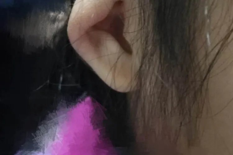 先天性耳朵畸形图片