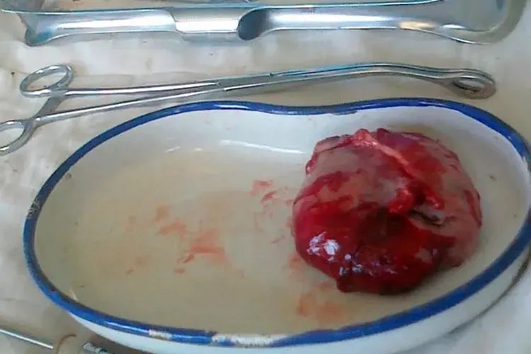 肌胎畸胎瘤图片