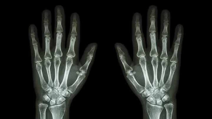 类风湿性关节炎饮食上要注意什么