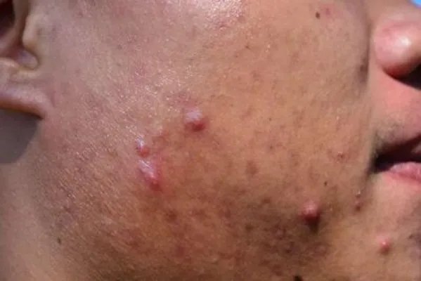 结节性硬化有什么危害 结节性硬化的五个危害须知