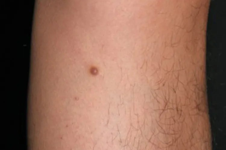 纤维瘤图片辨别