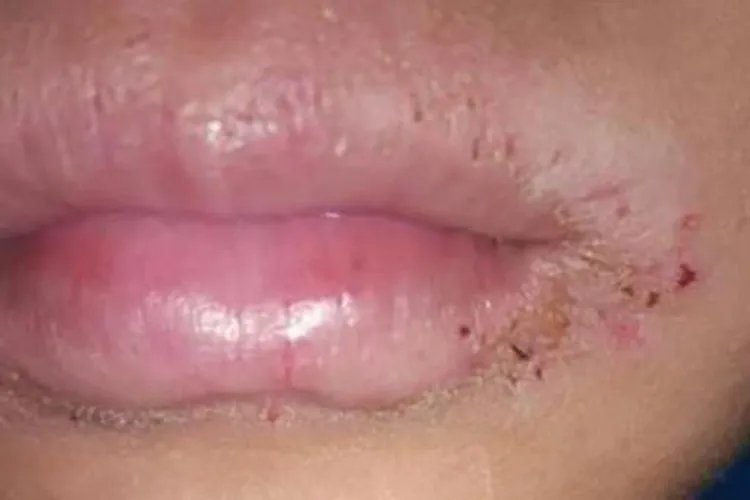 口腔白色念珠菌感染图片