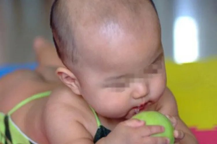 佝偻病儿童图片