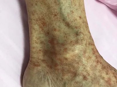 进行性色素性紫癜性皮肤病脚踝斑图片