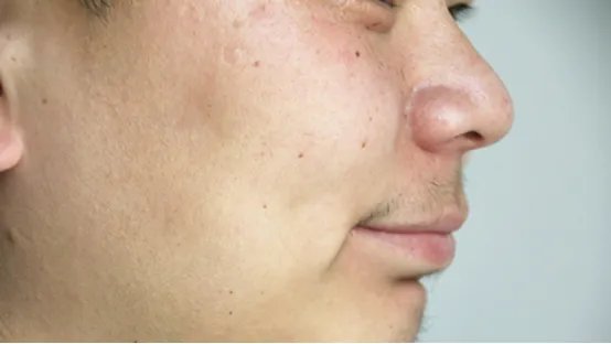 怎么去色素沉淀