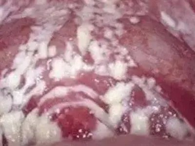 外阴阴道假丝酵母菌病豆腐渣白带图片