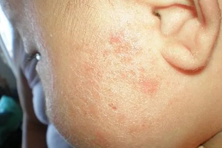 1个月婴儿湿疹图片