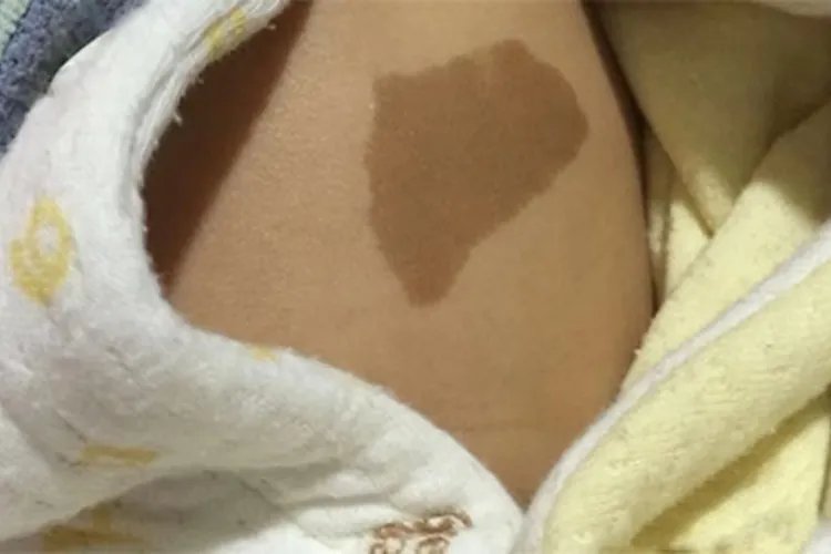 婴儿各种胎记图片