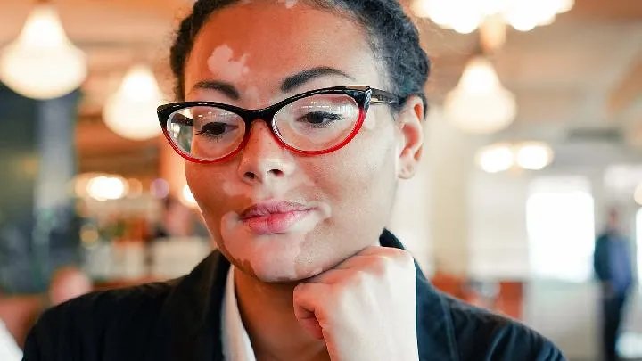 白癜风是什么病