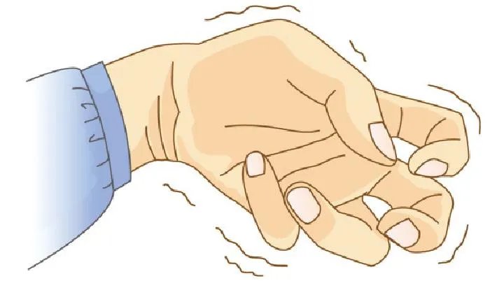 癫痫遗传吗需要注意什么