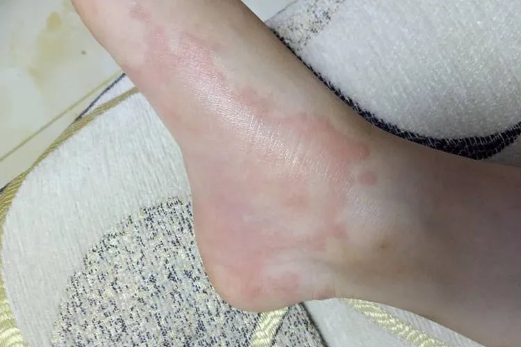 龙传丹症状图片