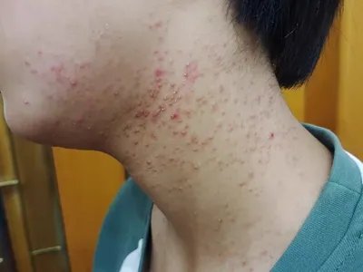 毛囊炎疙瘩图片