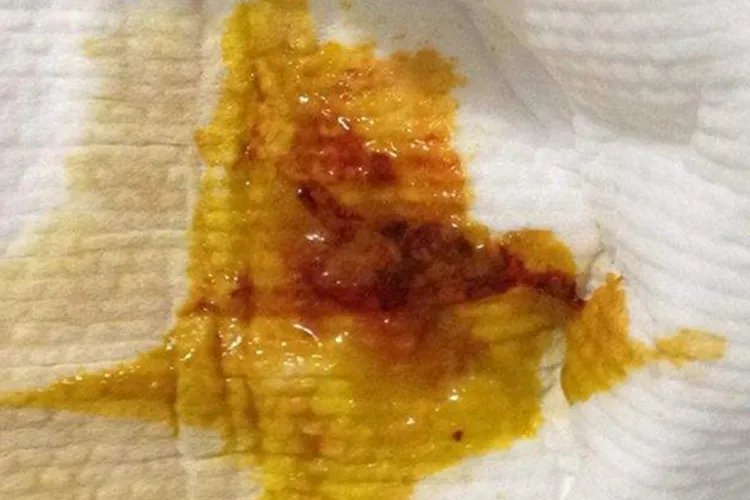 女性肠癌前兆大便照片