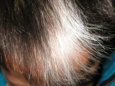 斑驳病头部症状图片