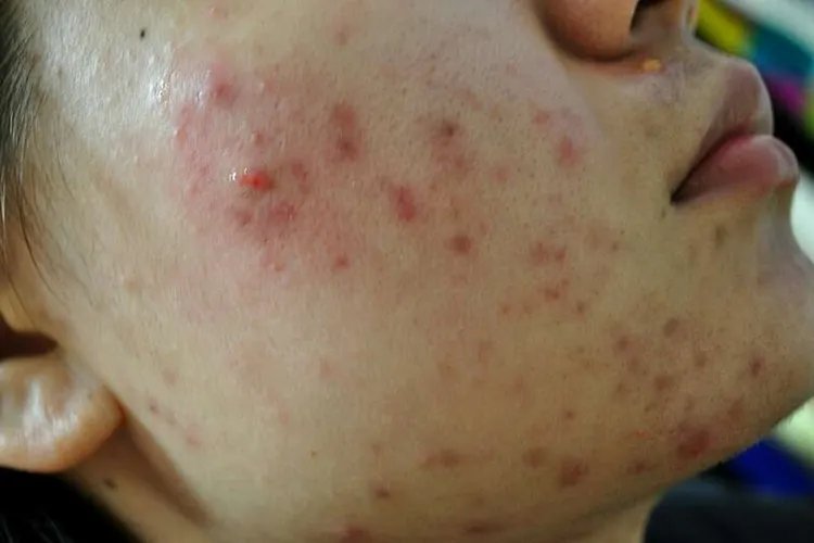 各种面部皮炎症状图片大全