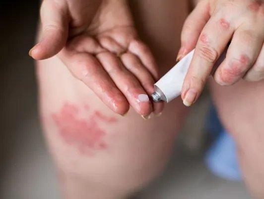 断痒拔毒膏的作用是什么