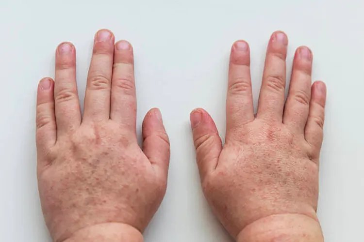 儿童猩红热皮疹图片