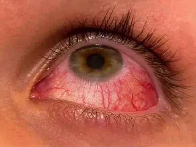 红眼病眼部症状图片