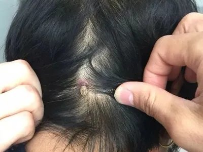 蜱咬伤红肿图片