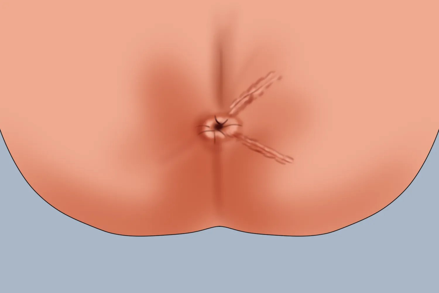 痔疮手术后的肛门图片