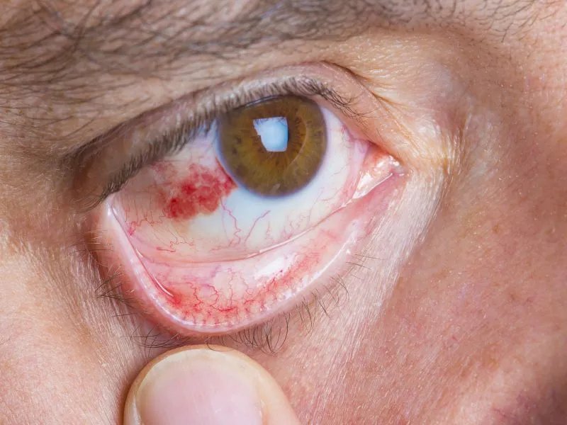 使用金霉素眼药膏有哪些注意事项