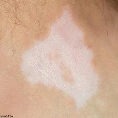 白芍总苷可以治白癜风吗