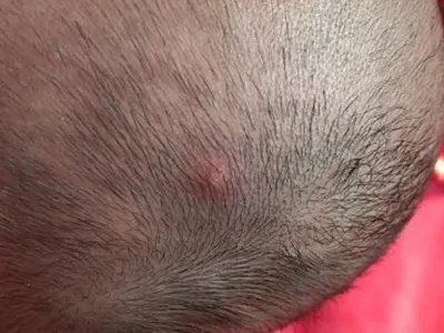 毛囊炎疙瘩图片