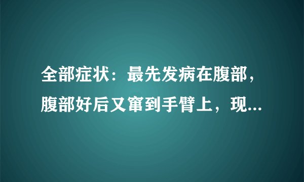 全部症状：最先发病在腹部，腹部好后又窜到手臂上，现在窜到脖子上了。发病时间及原因：87年治疗情况：吃了不少药，看了不少医生，擦了不少药，又打医生说是湿疹，有的又说是神经性皮炎，但治疗效果都不好。