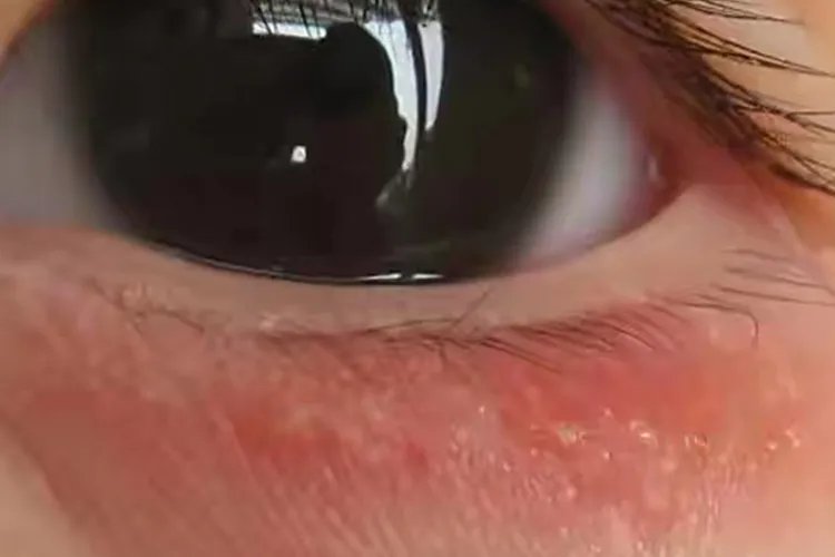 眼泪过敏症状图片