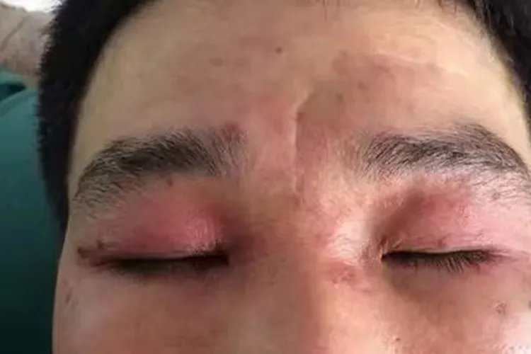 眼泪过敏症状图片